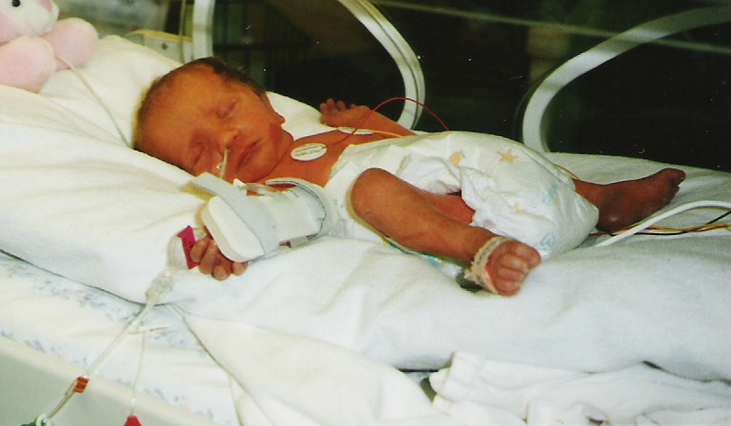 Hannah as a baby in the Special Care Baby Unit